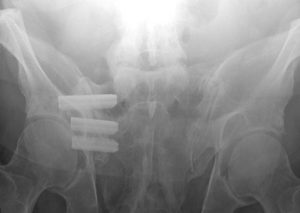 sacroiliac fusion san francisco