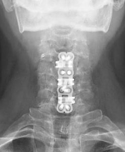 Spinal Fusion San Francisco
