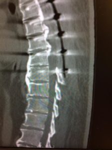 herinated disc san francisco | vertebroplasty san francisco
